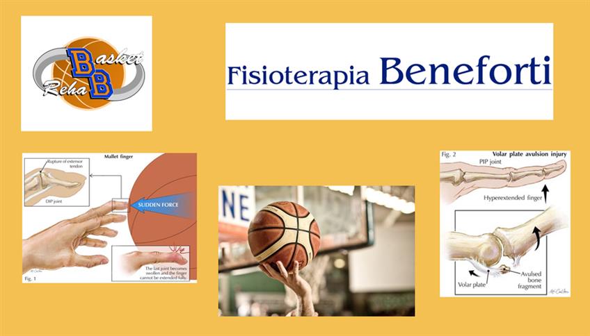 Come gestire e trattare gli infortuni alle dita nel giocatore di basket Come gestire e trattare gli infortuni alle dita nel giocatore di basket